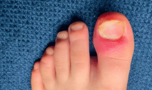 How Early Intervention Minimizes Long-term Discomfort in Ingrown Toenail Cases